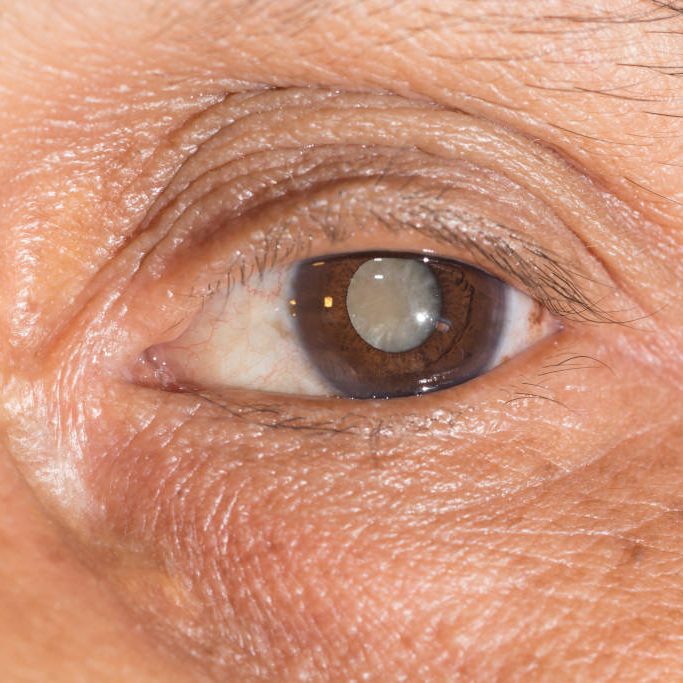 Close up of the mature cataract during eye examination.